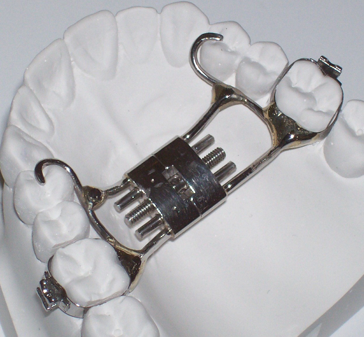 Types of Appliances Canyon Point Orthodontics Golden Boulder CO